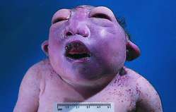 anencephaly.jpg