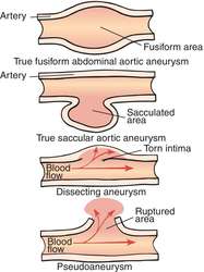 Congenital aneurysm | definition of congenital aneurysm by ...
