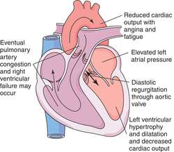 Aortic regurgitation | definition of aortic regurgitation by Medical ...