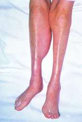 Baker cyst images