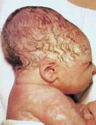 caput succedaneum