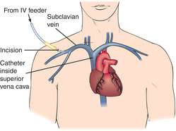 right subclavian triple lumen catheter