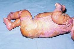 Image result for ichthyosis