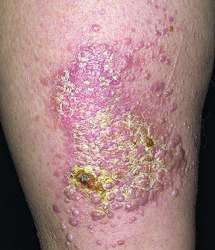 Lichen planus | definition of lichen planus by Medical dictionary