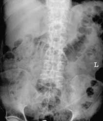 Osteopenia | definition of osteopenia by Medical dictionary