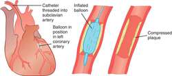 Percutaneous transluminal coronary angioplasty | definition of ...