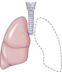 Pneumonectomy | definition of pneumonectomy by Medical dictionary