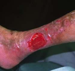 Diagnosis and Treatment of Venous Ulcers - American Family