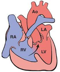 Tetralogy of Fallot | definition of tetralogy of Fallot by Medical ...