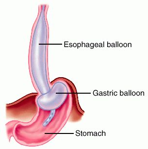 esophagogastric balloon tamponade