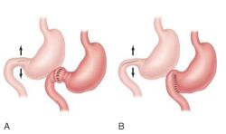 Finney Pyloroplasty