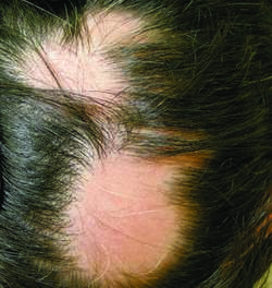 Alopecia meaning