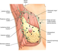 Definition of intraductal breast carcinoma - NCI Dictionary of
