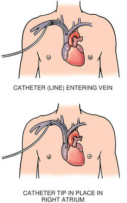 tesio catheter