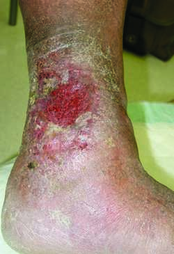 Miliaria Rubra: Causes, Symptoms, and Treatment - Skinsight