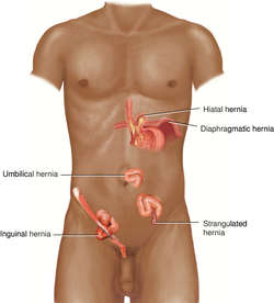 abdominal sports hernia