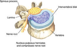 nucleus pulposus