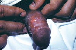 herpes male genitalia