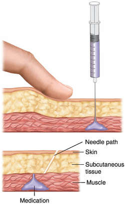 Injection (medicine) - Wikipedia