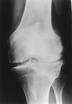 Deformáló artrózis 1. szakasz térdkezelés, Arthrózis (porckopás) tünetei és kezelése - HáziPatika