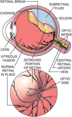 Retinal Tear Definition Of Retinal Tear By Medical Dictionary