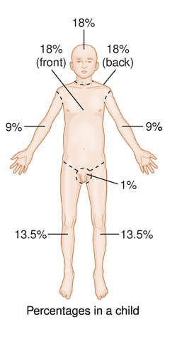 Rule Of Nines Burn Chart