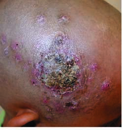 Tinea nigra - Wikipedia