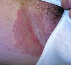 Tinea  definition of tinea by Medical dictionary