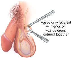 Vasectomy