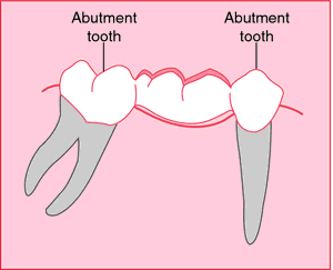 abutment teeth