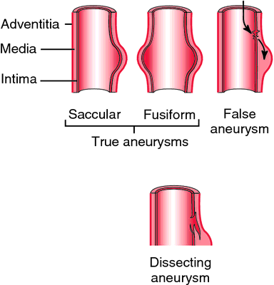 Fusiform aneurysm | definition of fusiform aneurysm by Medical dictionary