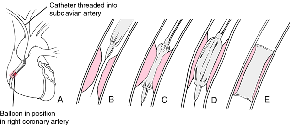 Balloon Angioplasty Definition Of Balloon Angioplasty By Medical Dictionary