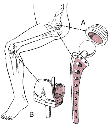 Arthrotomy Meaning