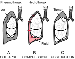 pneumothorax vs atelectasis