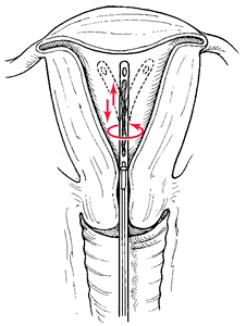 Aspiration biopsy  definition of aspiration biopsy by Medical dictionary