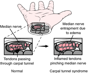 Carpal tunnel surgery - Wikipedia