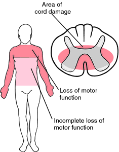 Central Cord Syndrome Definition Of Central Cord Syndrome By Medical Dictionary