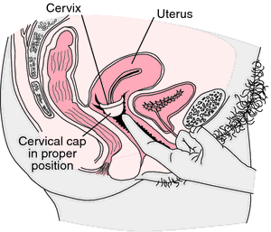 diaphragm vs cervical cap