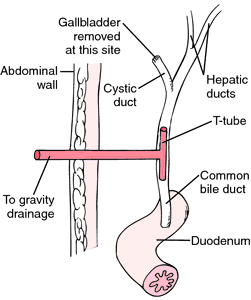 70 Choledocholithiasis Images, Stock Photos & Vectors | Shutterstock