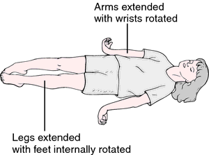 Decerebrate Rigidity Definition Of Decerebrate Rigidity By Medical Dictionary