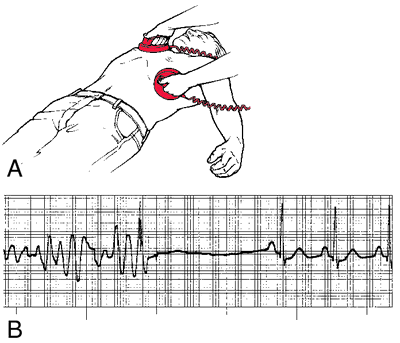 defibrillation