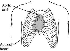 Dextrocardia Definition Of Dextrocardia By Medical Dictionary