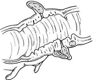 Esophageal diverticulum  definition of esophageal diverticulum by