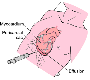 Pericardial effusion | definition of pericardial effusion ... diagram of chylothorax 