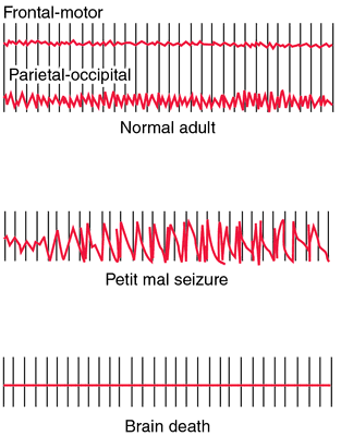 Ekg vs eeg - dallaslasopa