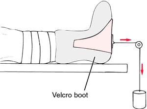 Buck S Extension Definition Of Buck S Extension By Medical Dictionary