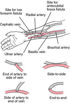 brachial cephalic fistula