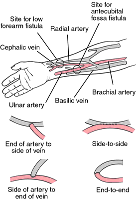 Arteriovenous Fistula Definition Of Arteriovenous Fistula By Medical Dictionary