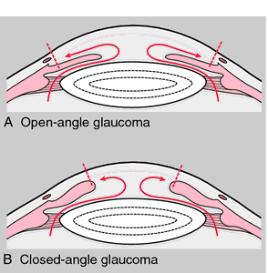 closed angle glaucoma vs open angle