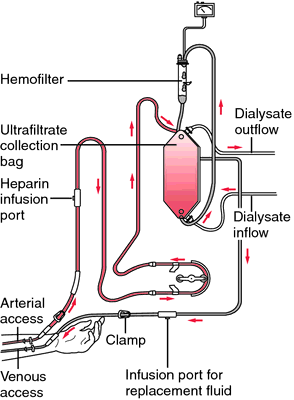 Hemodialysis Definition Of Hemodialysis By Medical Dictionary